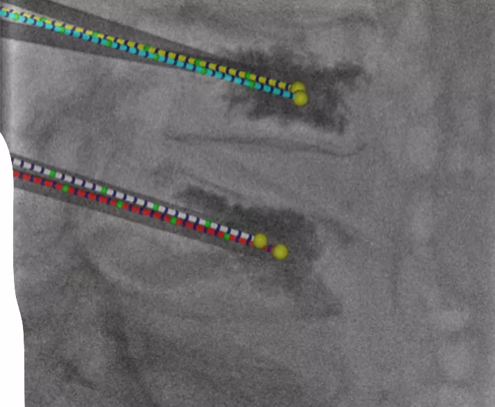 Tracked needle placement during image-guided procedure.