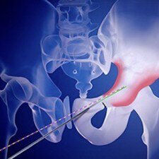 needle-assist-product-tile-en