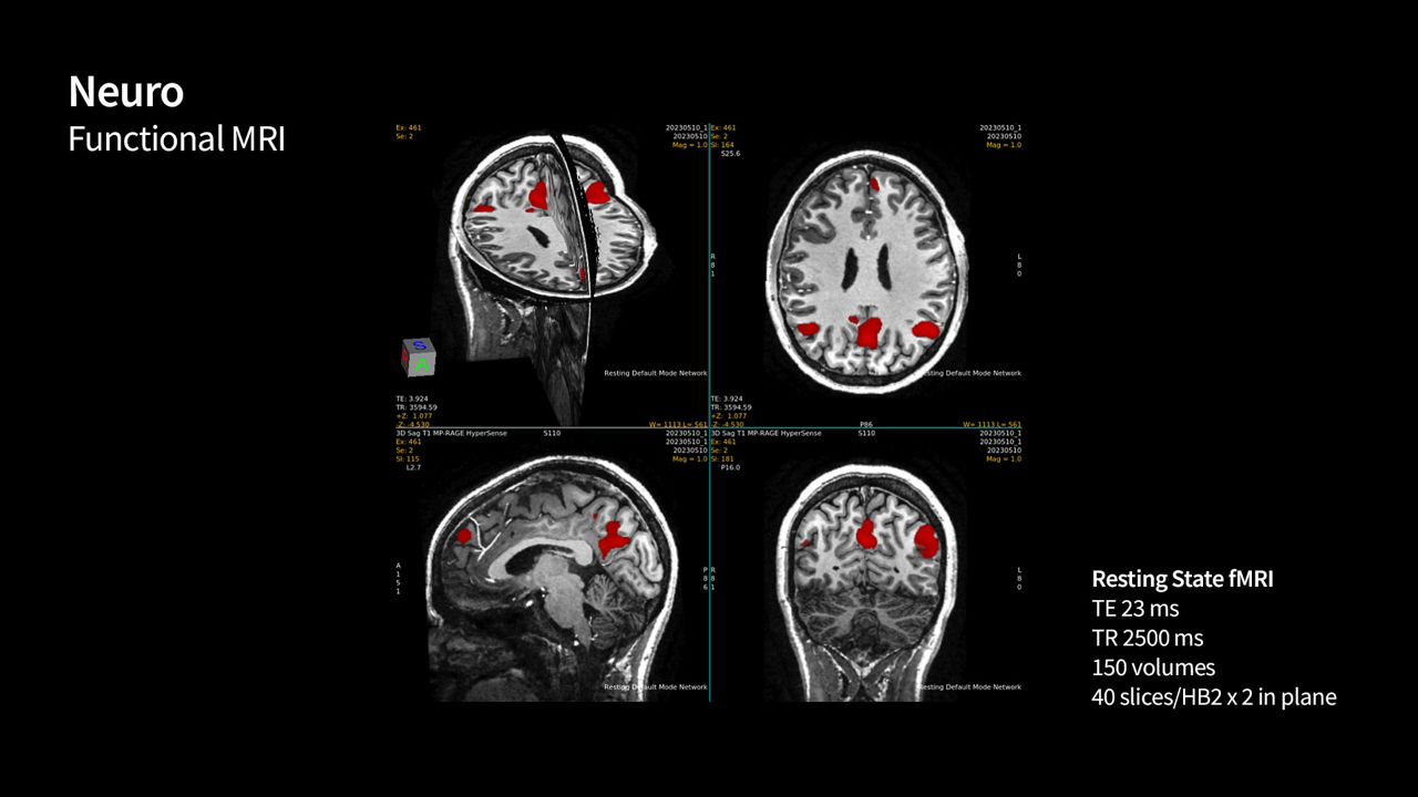 SIGNA 7T MRI scanner clinical images | GE HealthCare (Global English)