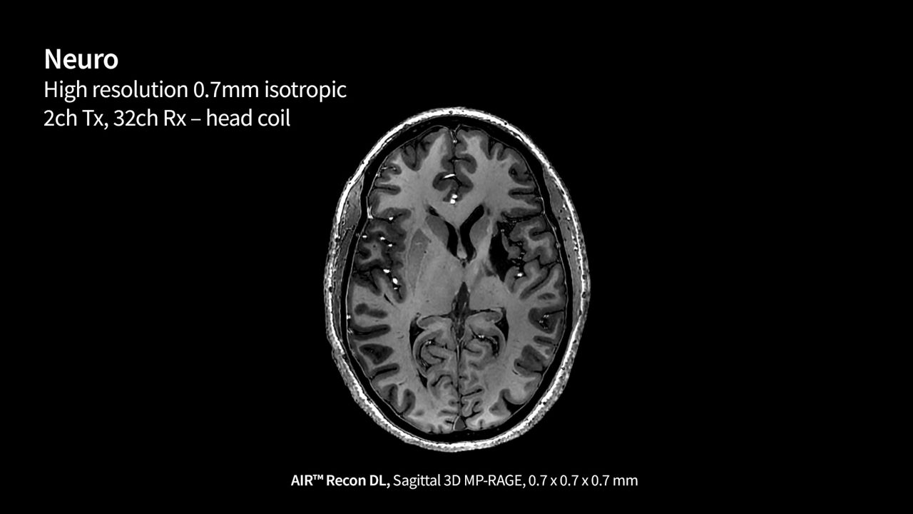 SIGNA 7T MRI scanner clinical images | GE HealthCare (Global English)