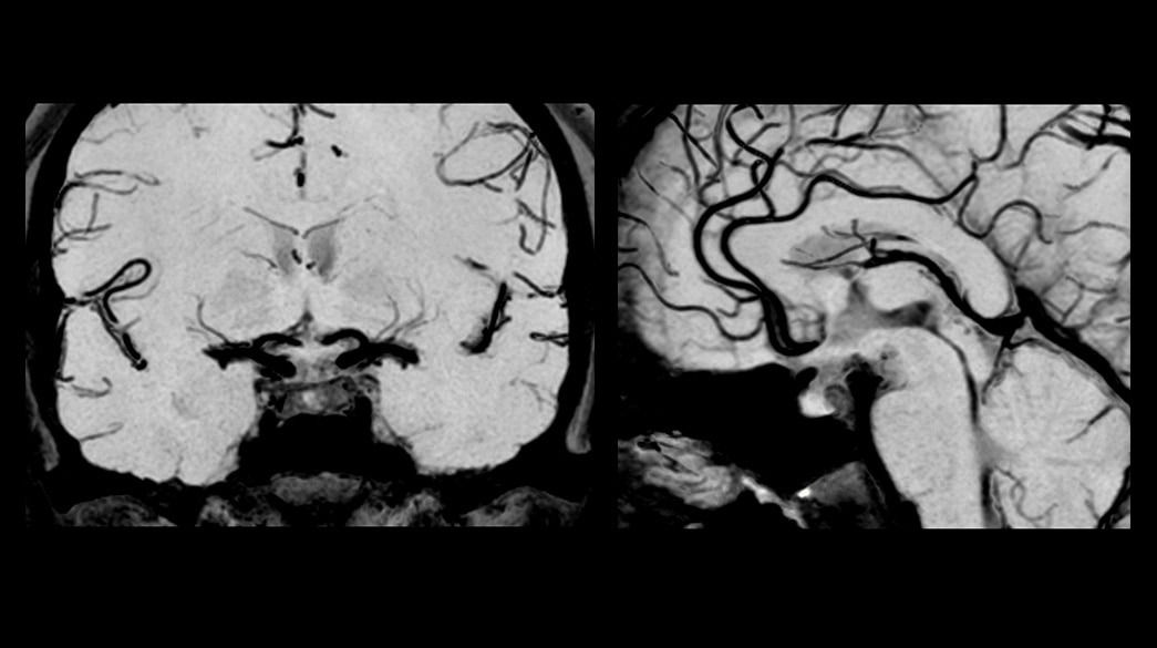 <p>3D CUBE MSDE (Vessel Wall Imaging) - Compatible with AIR™ Recon DL</p>
