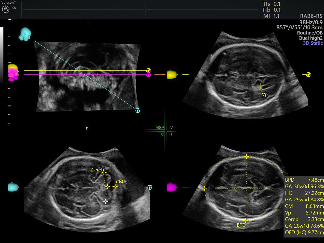 new-voluson-s8t-sonocns-image-ci-en