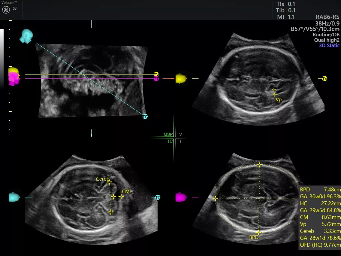 new-voluson-s8t-sonocns-image-ci-en