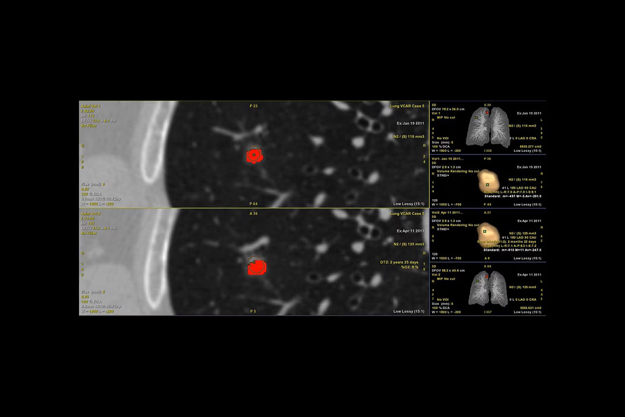nodule-analysis-follow-up-ci-en