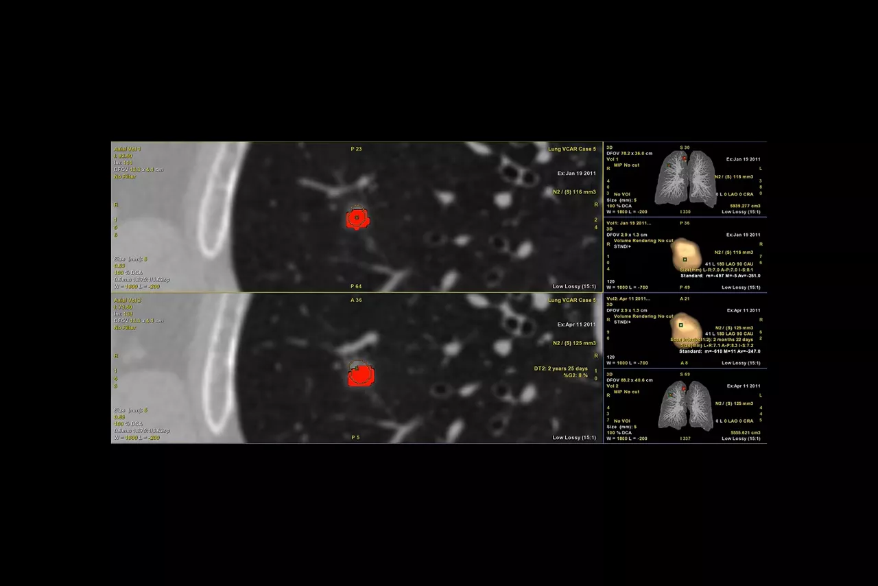 nodule-analysis-follow-up-ci-en