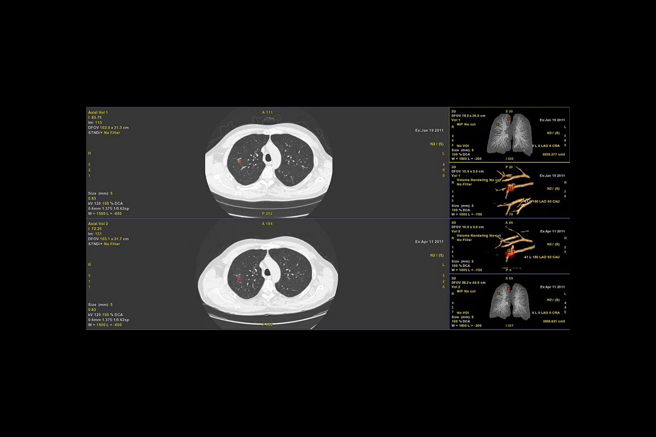 nodule-tracking-and-follow-up-ci-en