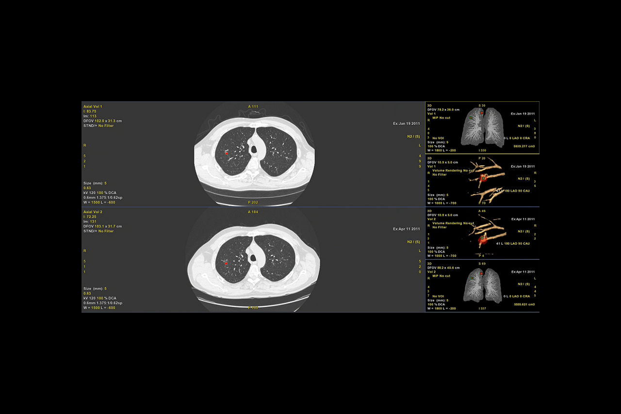 Nodule tracking and follow-up_desktop