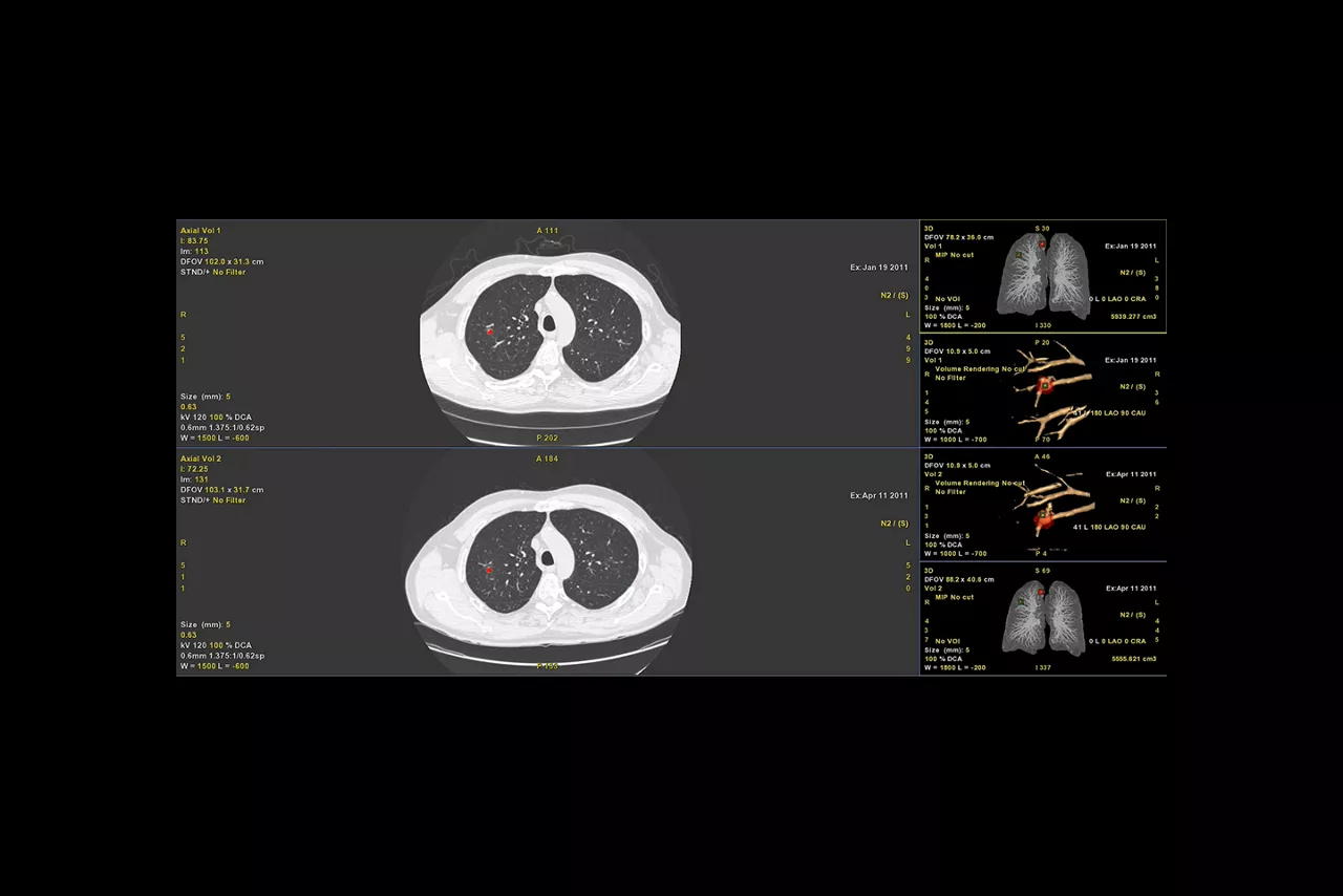 Nodule tracking and follow-up_desktop