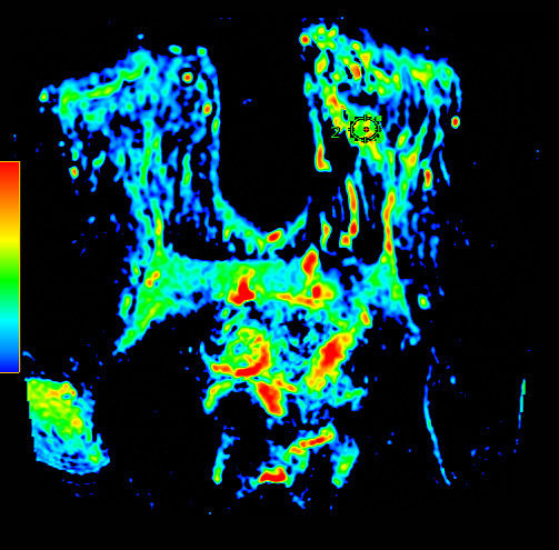 not-clone-advanced-visualization-applications-oncoquant-aw-oncoquant-overview-clinical.jpg