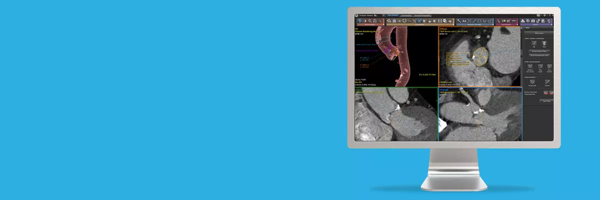 not-clone-advanced-visualization-applications-tavi analysis-aw-tavi-analysis-spotlight.jpg