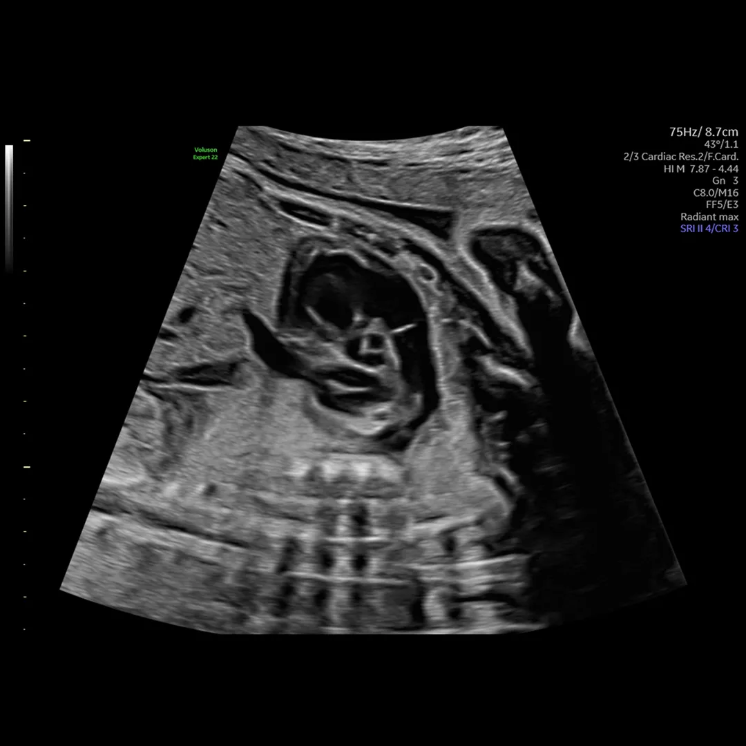 Comparison of two images, showing the Augment feature