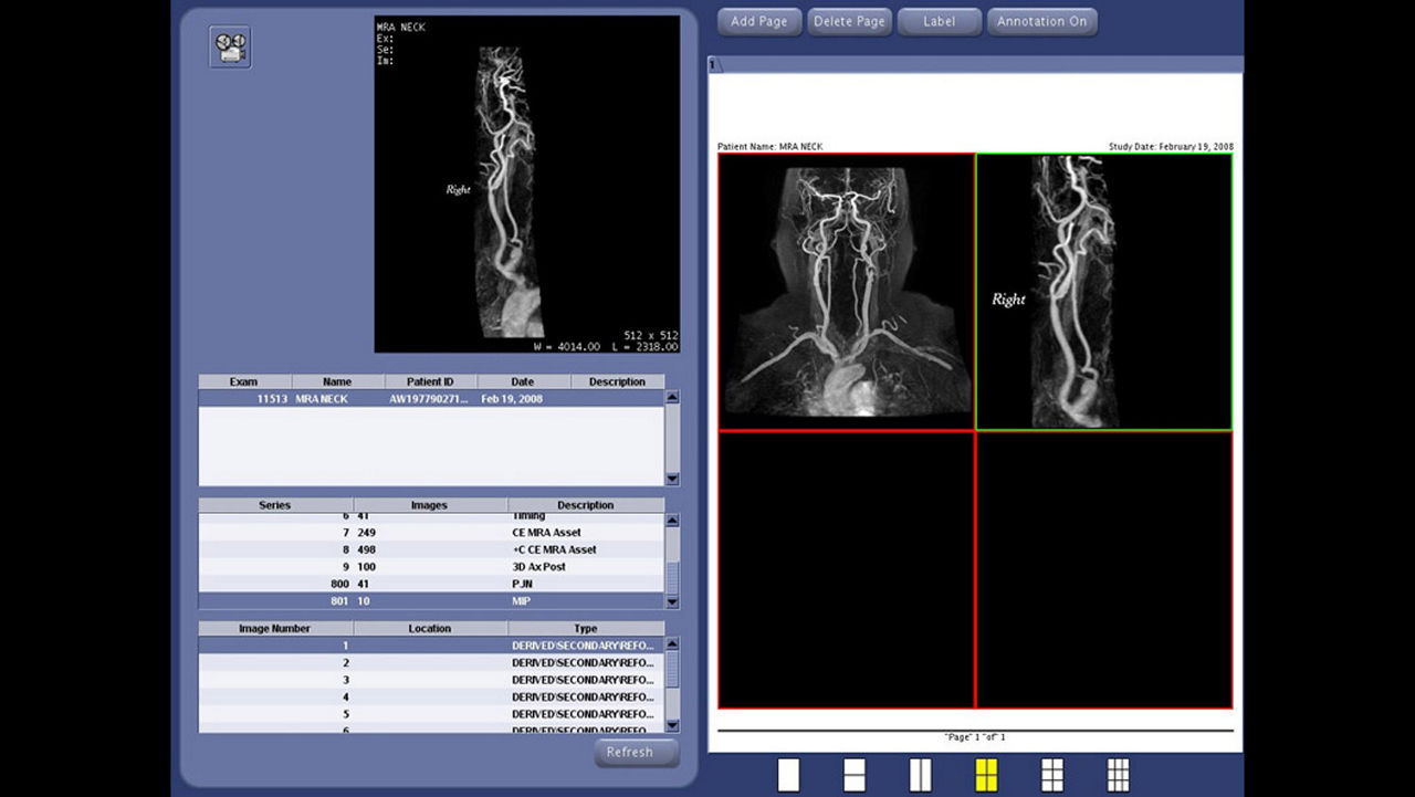 one-advanced-visualization-applications-angiocard-image-gallery-aw-angiocard-clinical4