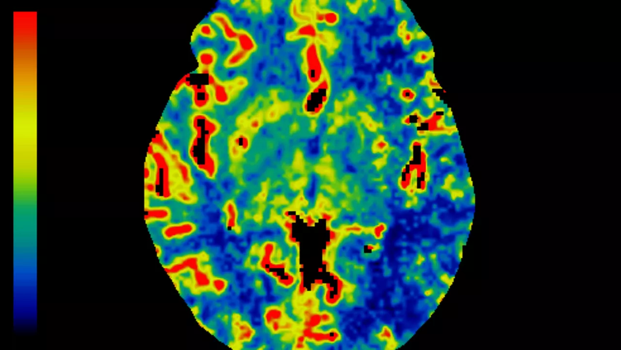 visualização avançada de tc no perfusion 4d.