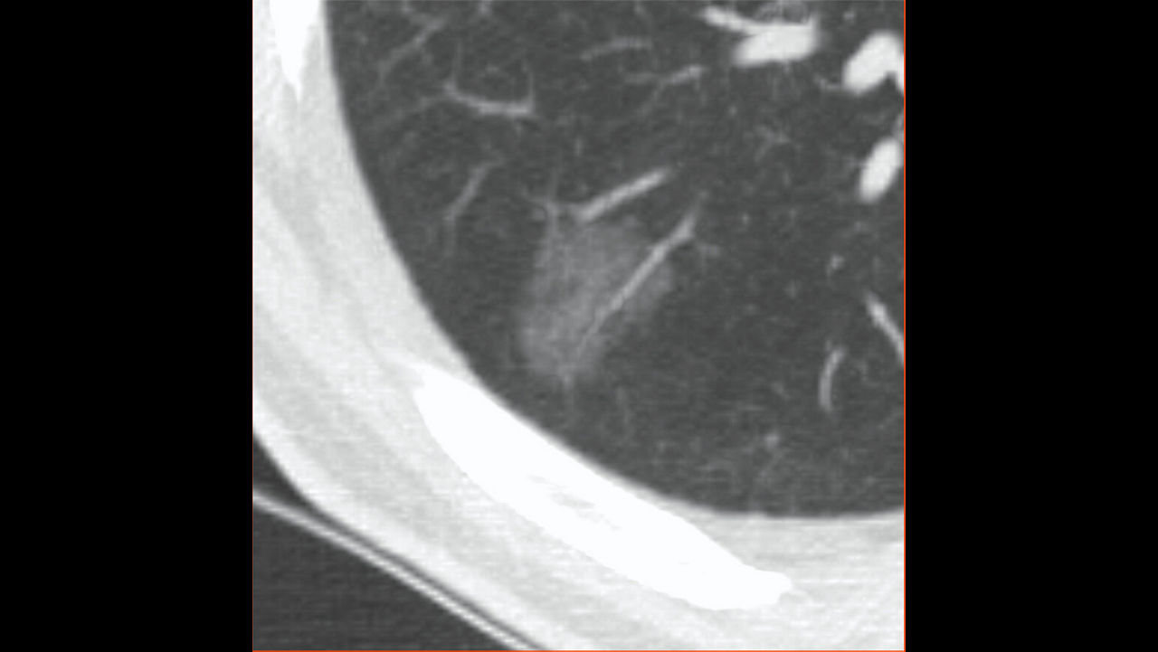 one-advanced-visualization-applications-lung-vcar-image-gallery-aw-lung-vcar-clinical1