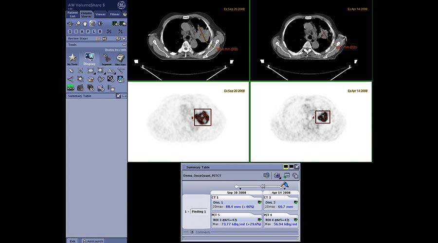 one-advanced-visualization-applications-oncoquant-image-gallery-aw-oncoquant-clinical1