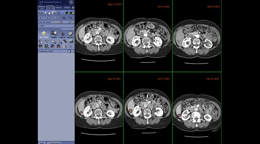 one-advanced-visualization-applications-oncoquant-image-gallery-aw-oncoquant-clinical2