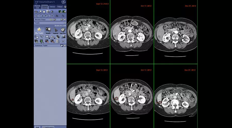 one-advanced-visualization-applications-oncoquant-image-gallery-aw-oncoquant-clinical2