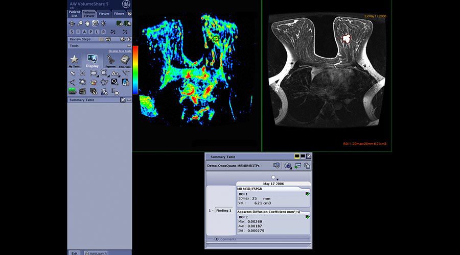 one-advanced-visualization-applications-oncoquant-image-gallery-aw-oncoquant-clinical3