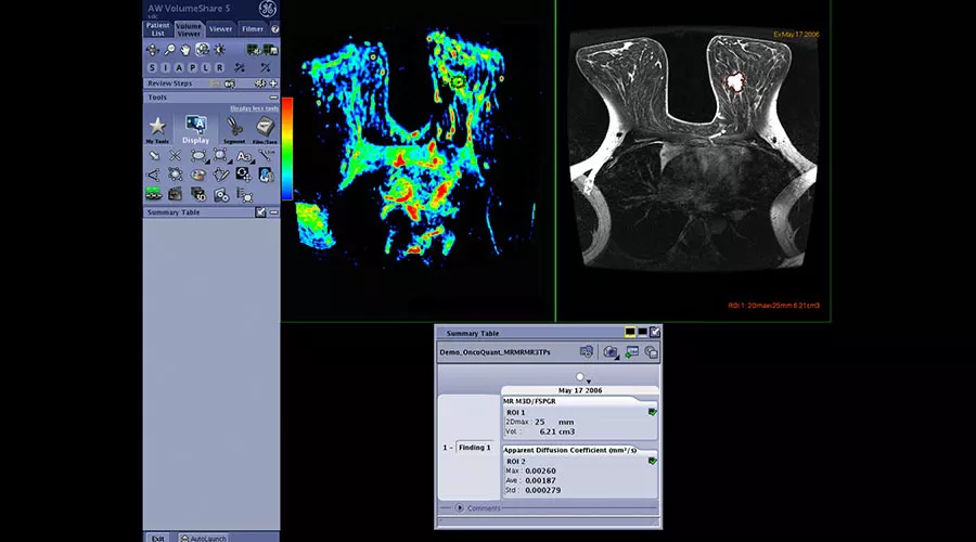 one-advanced-visualization-applications-oncoquant-image-gallery-aw-oncoquant-clinical3
