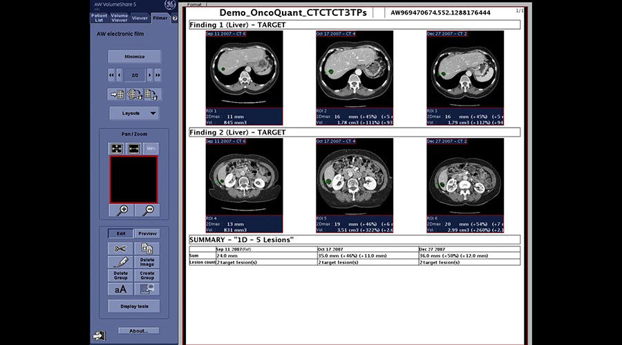 one-advanced-visualization-applications-oncoquant-image-gallery-aw-oncoquant-clinical4
