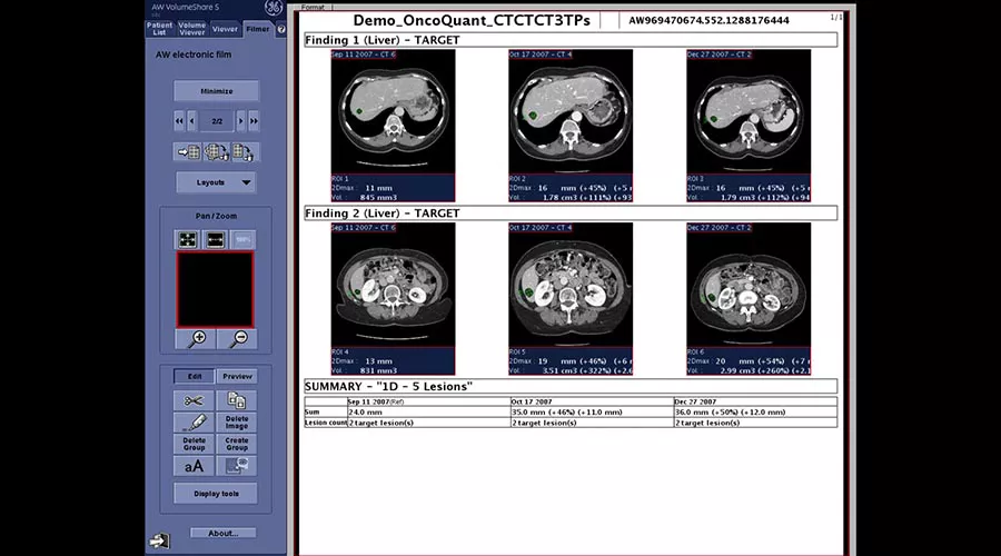 one-advanced-visualization-applications-oncoquant-image-gallery-aw-oncoquant-clinical4