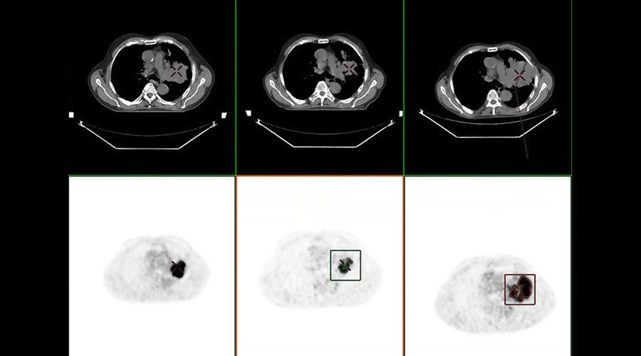 one-advanced-visualization-applications-oncoquant-image-gallery-aw-oncoquant-clinical5