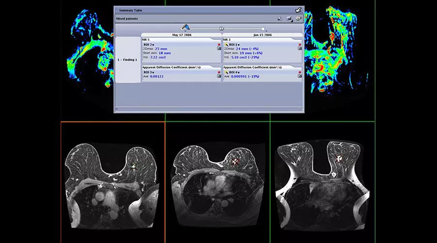 one-advanced-visualization-applications-oncoquant-image-gallery-aw-oncoquant-clinical6