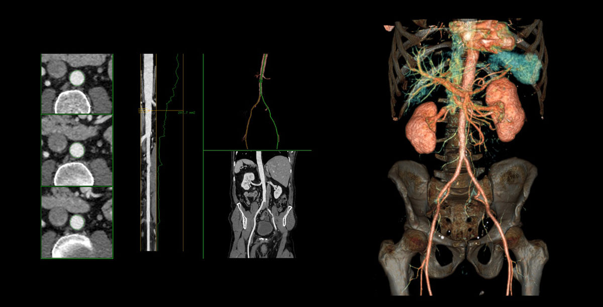 OptimaCT-CG-Vascular03