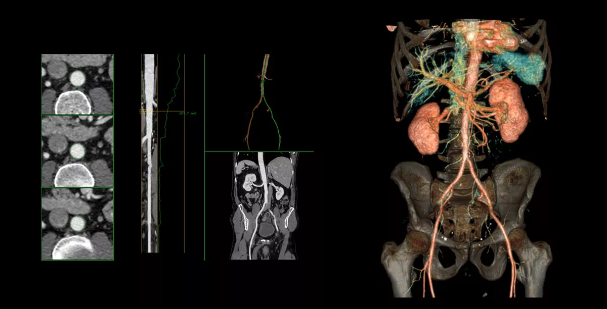 OptimaCT-CG-Vascular03