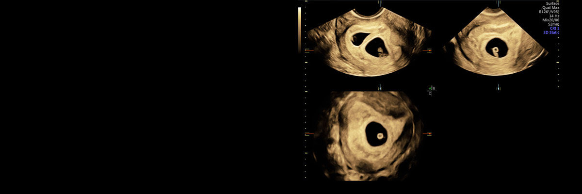 ound-voluson-voluson family-voluson e10-probes-voluson-e10-high-utilized_1st_trimester.jpg