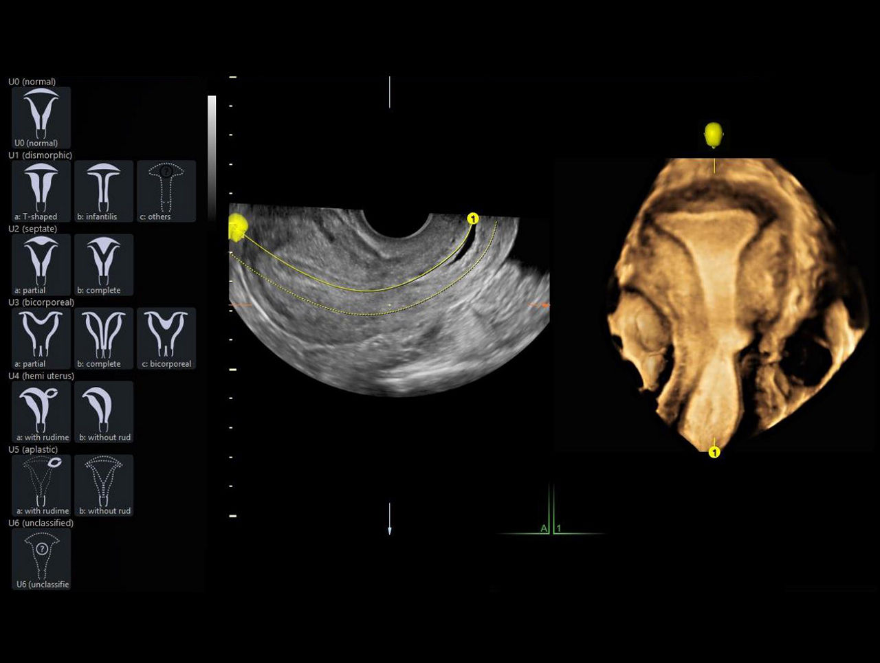 Uterine Classification of GE Healthcare voluson technology