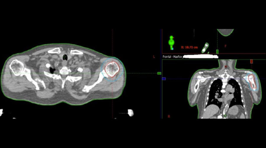 Patients-with-prostate-cancer-metastasis-to-left-shoulder-Full-Size