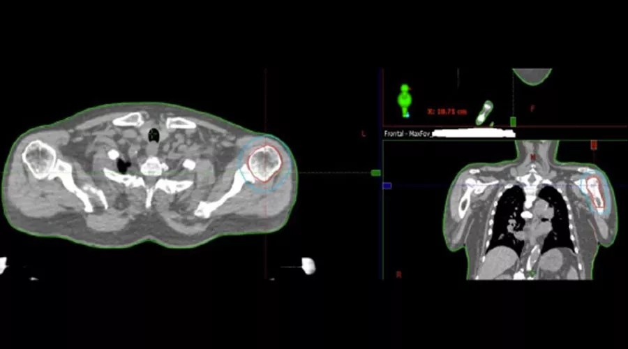 Patients-with-prostate-cancer-metastasis-to-left-shoulder-Full-Size