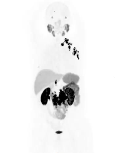 PETCT-Feature 1