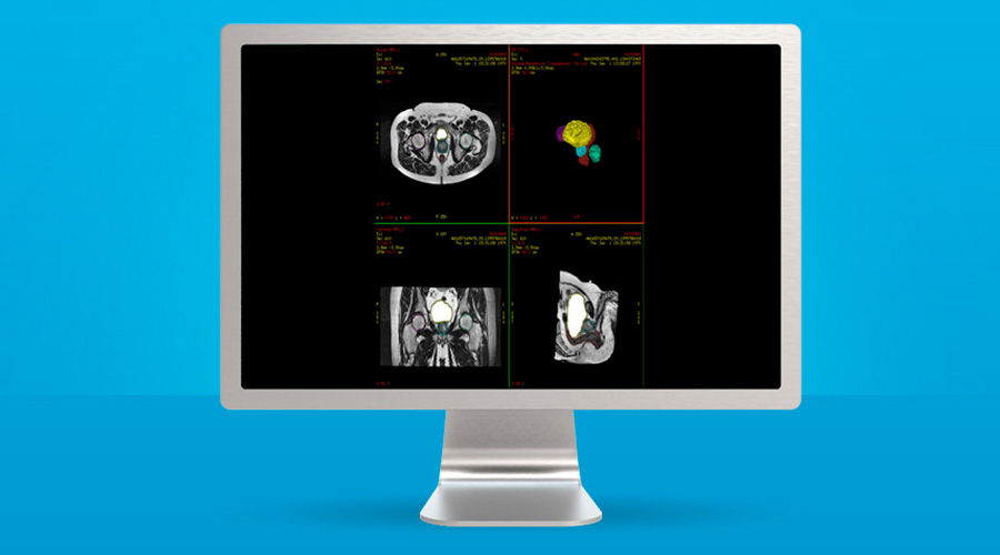 plications-advantagesim-md-gehc-advantagesim-md-spotlight-mr-pelvic-organ-segmentation