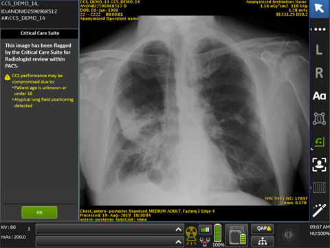 Optima XR240amx with Critical Care Suite - Intelligence at point of care to detect critical findings (PTX)