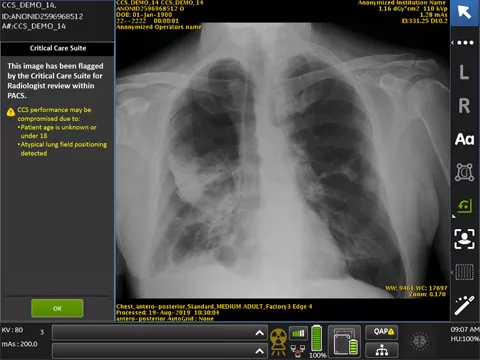 Optima XR240amx with Critical Care Suite - Intelligence at point of care to detect critical findings (PTX)
