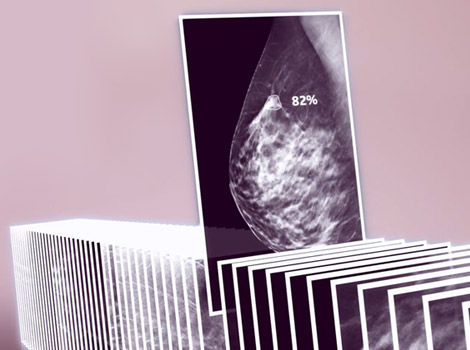ProFound AI for Senographe Pristina