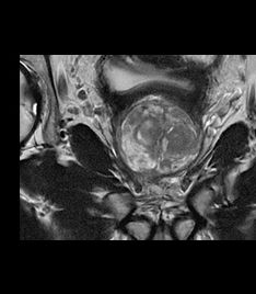 Prostate-radiomed-532x335