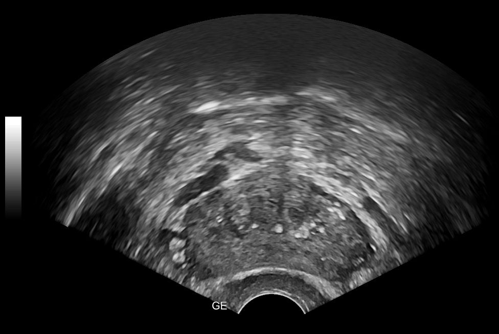 prostate with stones