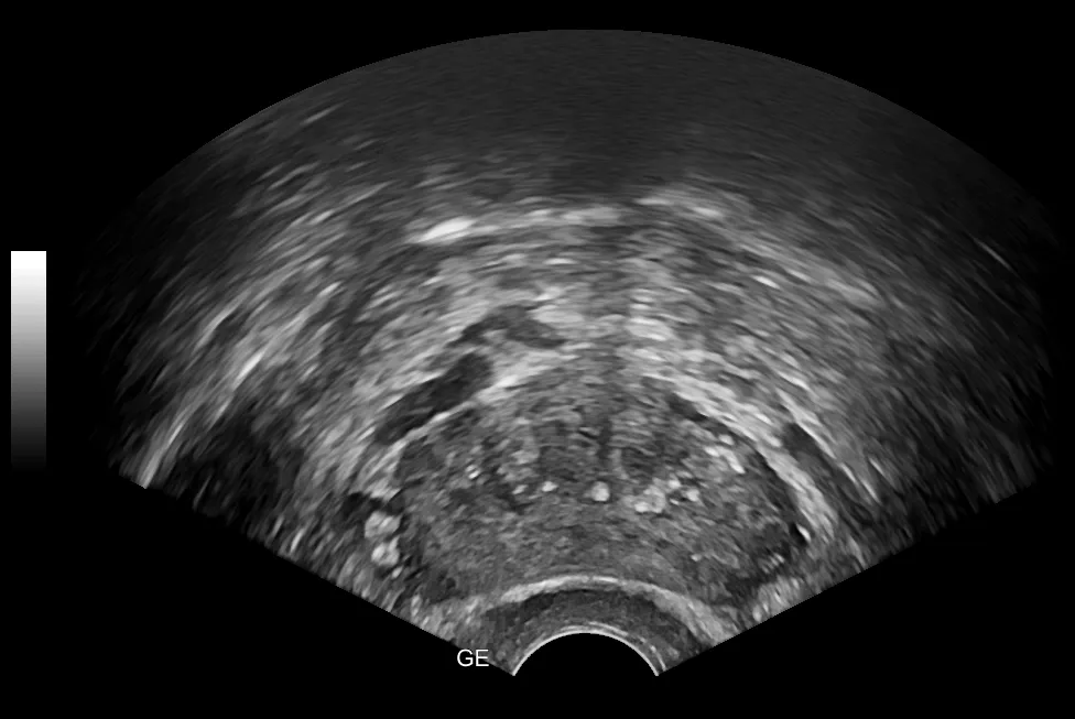 prostate with stones