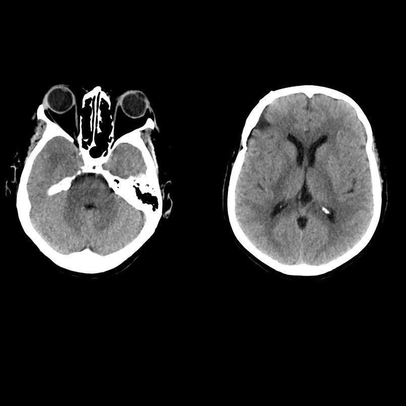 puted-tomography-revolution ct-clinical images-neurology-routine brain in one rotation.jpg