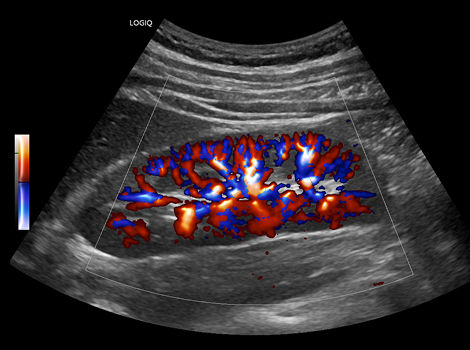 Radiantflow on LOGIQ E10 Series Ultrasound