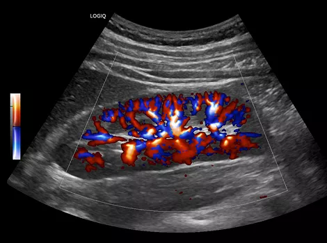 Radiantflow on LOGIQ E10 Series Ultrasound