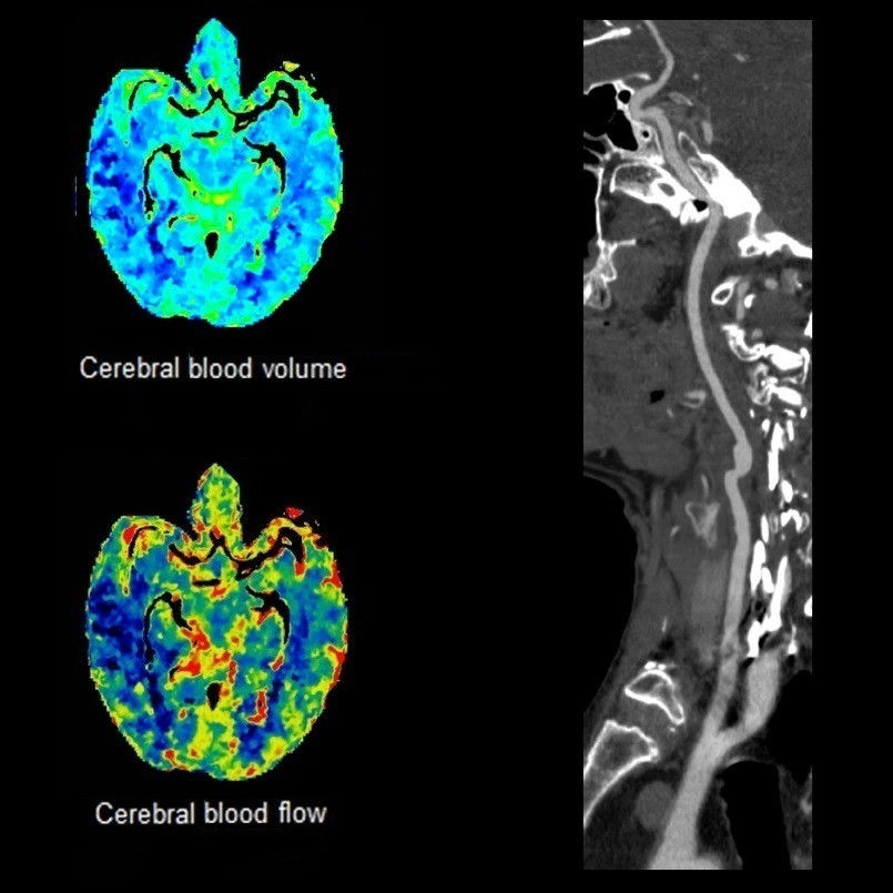 raphy-revolution ct-clinical images-neurology-whole brain perfusion with head and neck.jpg