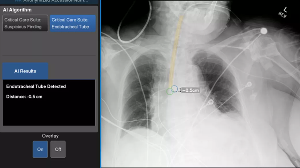 Next gen fixed X-ray system: Definium™ Tempo