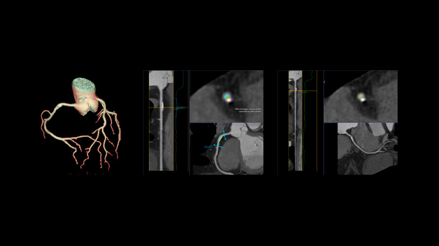revolution cardiac2