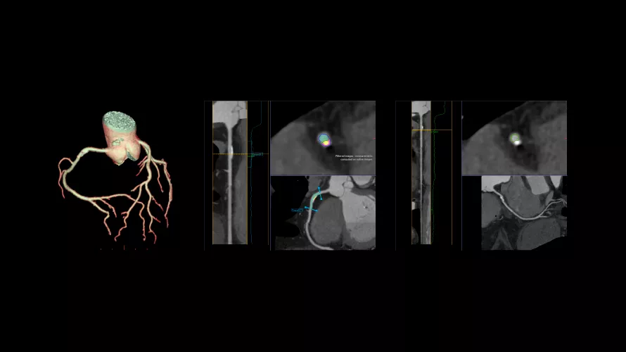 revolution cardiac2