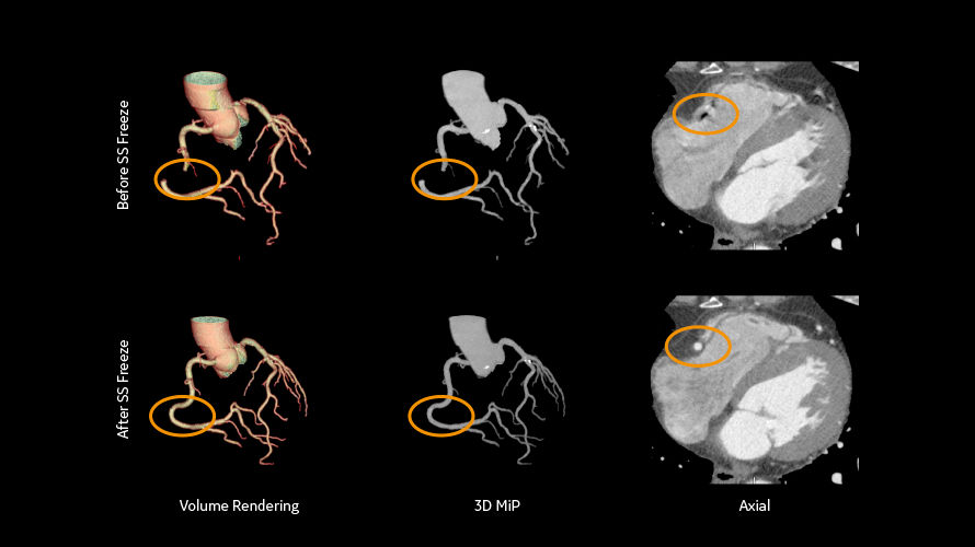 revolution cardiac4