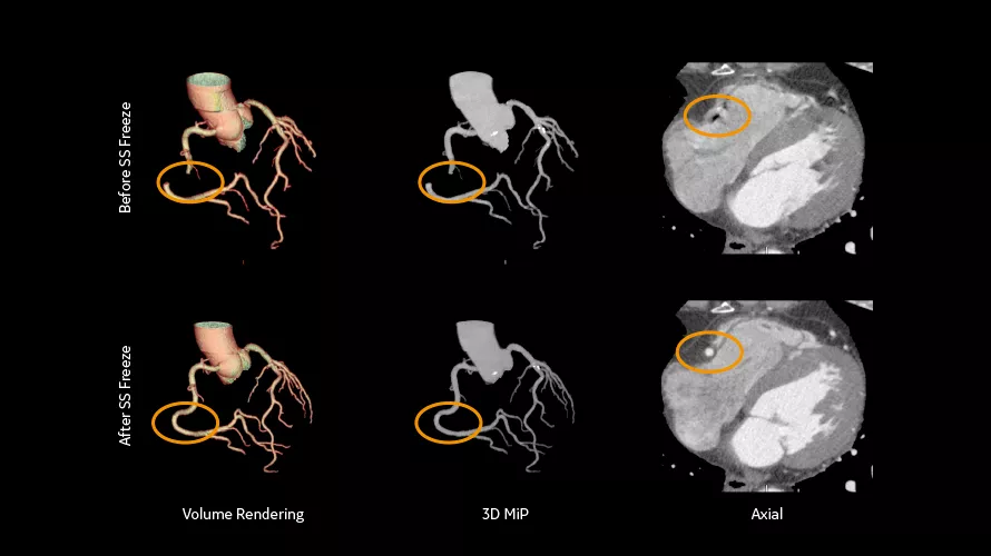 revolution cardiac4